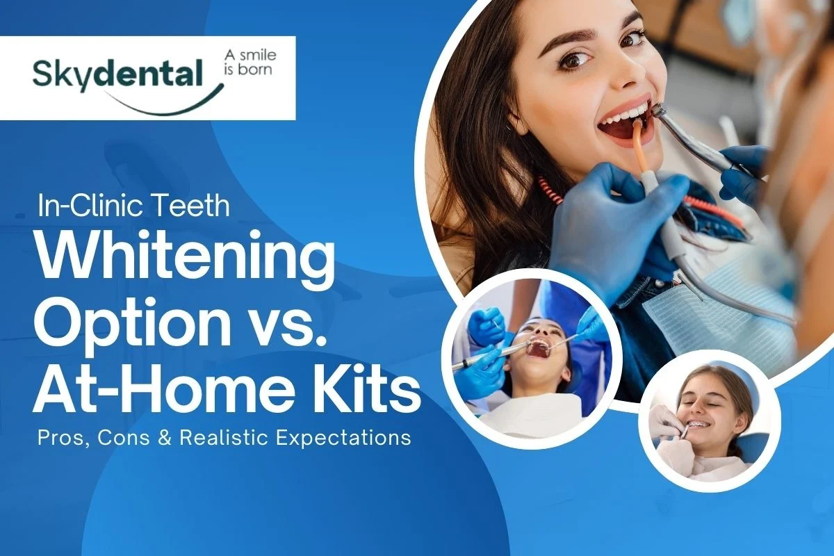 In-Clinic Teeth Whitening in Albania vs. At-Home Kits: Pros, Cons & Realistic Expectations